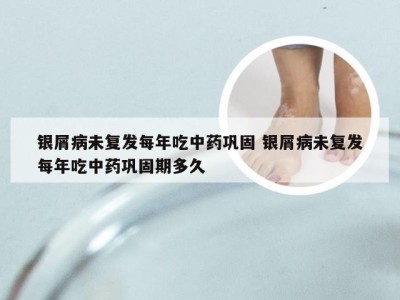 银屑病未复发每年吃中药巩固 银屑病未复发每年吃中药巩固期多久
