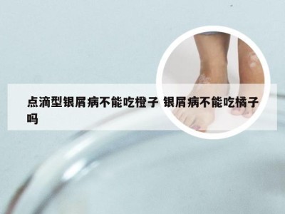 点滴型银屑病不能吃橙子 银屑病不能吃橘子吗