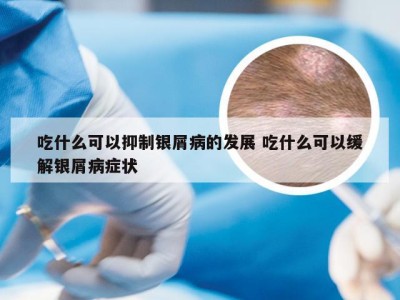吃什么可以抑制银屑病的发展 吃什么可以缓解银屑病症状