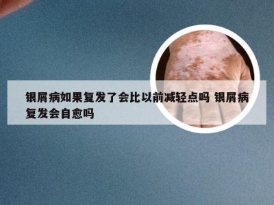 银屑病如果复发了会比以前减轻点吗 银屑病复发会自愈吗