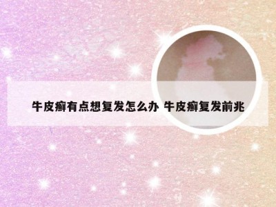 牛皮癣有点想复发怎么办 牛皮癣复发前兆