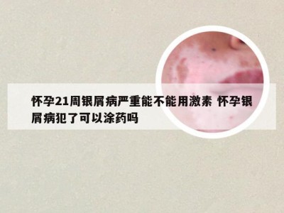 怀孕21周银屑病严重能不能用激素 怀孕银屑病犯了可以涂药吗