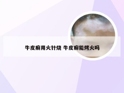 牛皮癣用火针烧 牛皮癣能烤火吗
