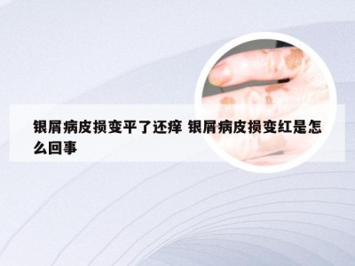 银屑病皮损变平了还痒 银屑病皮损变红是怎么回事
