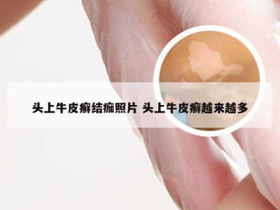 头上牛皮癣结痂照片 头上牛皮癣越来越多