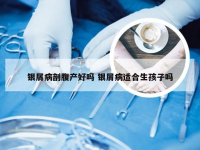 银屑病剖腹产好吗 银屑病适合生孩子吗