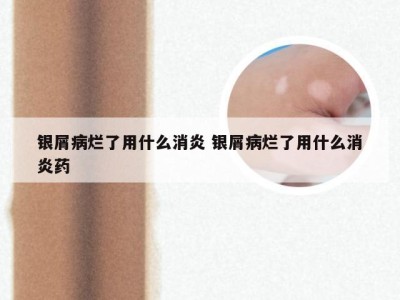银屑病烂了用什么消炎 银屑病烂了用什么消炎药