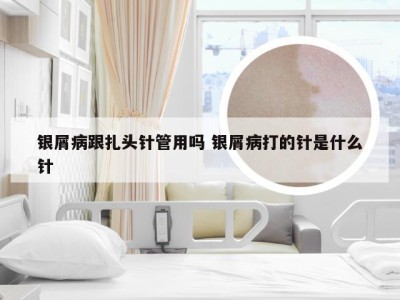 银屑病跟扎头针管用吗 银屑病打的针是什么针