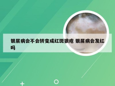银屑病会不会转变成红斑狼疮 银屑病会发红吗