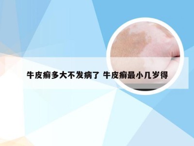牛皮癣多大不发病了 牛皮癣最小几岁得
