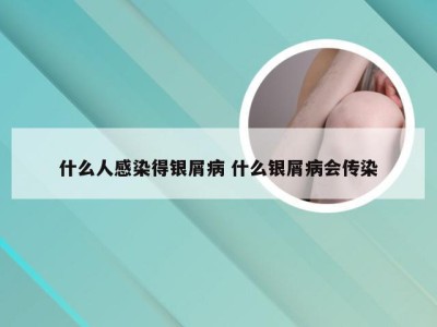 什么人感染得银屑病 什么银屑病会传染