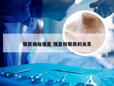 银屑病加强直 强直和银屑的关系