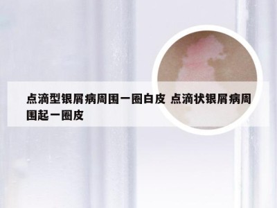 点滴型银屑病周围一圈白皮 点滴状银屑病周围起一圈皮
