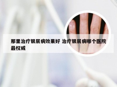 那里治疗银屑病效果好 治疗银屑病哪个医院最权威