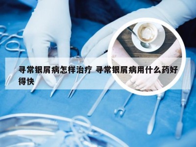 寻常银屑病怎样治疗 寻常银屑病用什么药好得快
