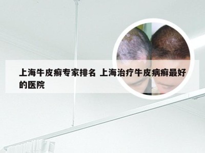 上海牛皮癣专家排名 上海治疗牛皮病癣最好的医院