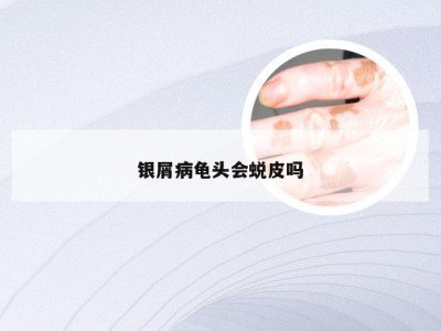银屑病龟头会蜕皮吗
