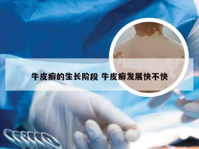 牛皮癣的生长阶段 牛皮癣发展快不快