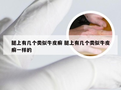 腿上有几个类似牛皮癣 腿上有几个类似牛皮癣一样的