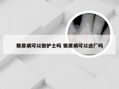 银屑病可以做护士吗 银屑病可以进厂吗