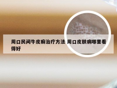 周口民间牛皮癣治疗方法 周口皮肤病哪里看得好