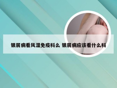银屑病看风湿免疫科么 银屑病应该看什么科