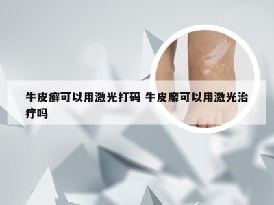 牛皮癣可以用激光打码 牛皮廨可以用激光治疗吗