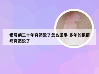 银屑病三十年突然没了怎么回事 多年的银屑病突然没了