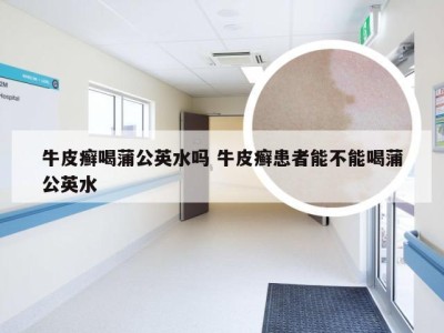 牛皮癣喝蒲公英水吗 牛皮癣患者能不能喝蒲公英水