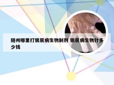 随州哪里打银屑病生物制剂 银屑病生物针多少钱