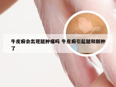 牛皮癣会出现腿肿痛吗 牛皮癣引起腿和脚肿了