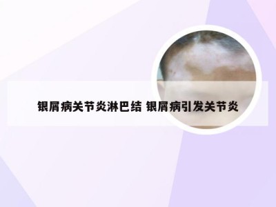 银屑病关节炎淋巴结 银屑病引发关节炎