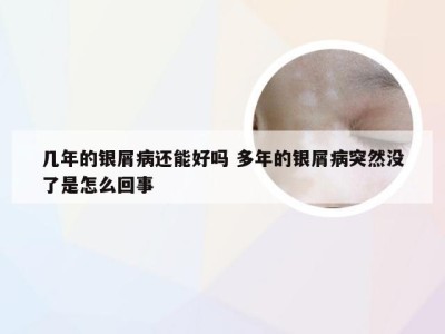 几年的银屑病还能好吗 多年的银屑病突然没了是怎么回事