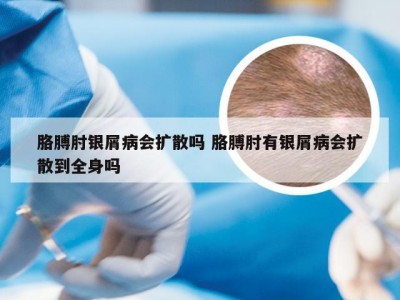 胳膊肘银屑病会扩散吗 胳膊肘有银屑病会扩散到全身吗