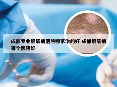 成都专业银屑病医院哪家治的好 成都银屑病哪个医院好