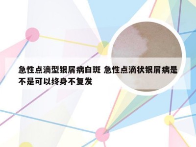 急性点滴型银屑病白斑 急性点滴状银屑病是不是可以终身不复发