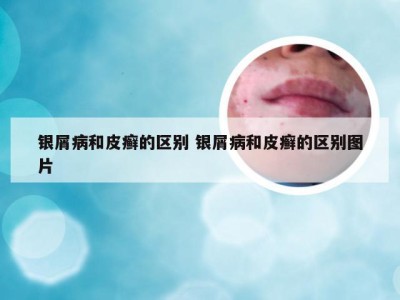 银屑病和皮癣的区别 银屑病和皮癣的区别图片