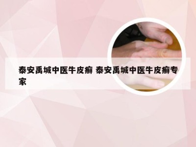 泰安禹城中医牛皮癣 泰安禹城中医牛皮癣专家