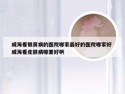 威海看银屑病的医院哪家最好的医院哪家好 威海看皮肤病哪里好啊