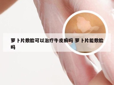 萝卜片敷脸可以治疗牛皮癣吗 萝卜片能敷脸吗