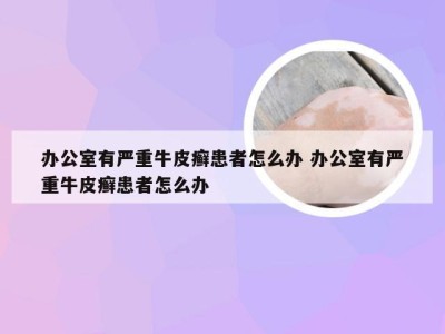 办公室有严重牛皮癣患者怎么办 办公室有严重牛皮癣患者怎么办