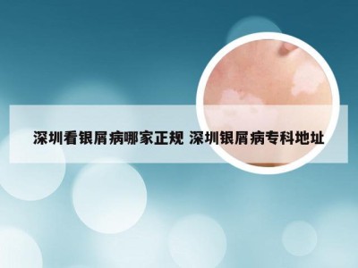 深圳看银屑病哪家正规 深圳银屑病专科地址