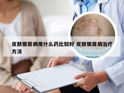 皮肤银屑病用什么药比较好 皮肤银屑病治疗方法