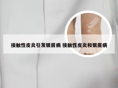 接触性皮炎引发银屑病 接触性皮炎和银屑病