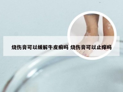 烧伤膏可以缓解牛皮癣吗 烧伤膏可以止痒吗