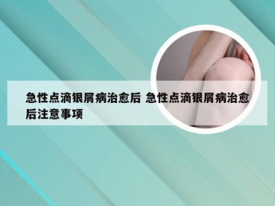 急性点滴银屑病治愈后 急性点滴银屑病治愈后注意事项