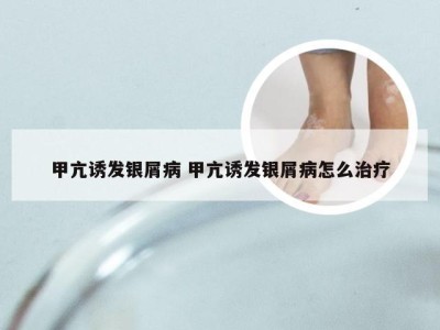 甲亢诱发银屑病 甲亢诱发银屑病怎么治疗