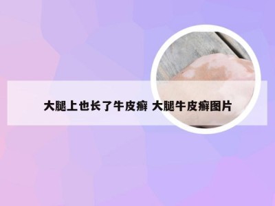 大腿上也长了牛皮癣 大腿牛皮癣图片