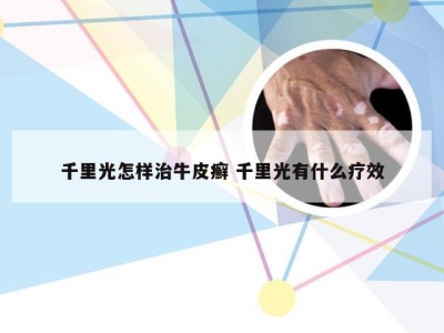 千里光怎样治牛皮癣 千里光有什么疗效