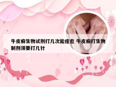 牛皮癣生物试剂打几次能痊愈 牛皮癣打生物制剂须要打几针